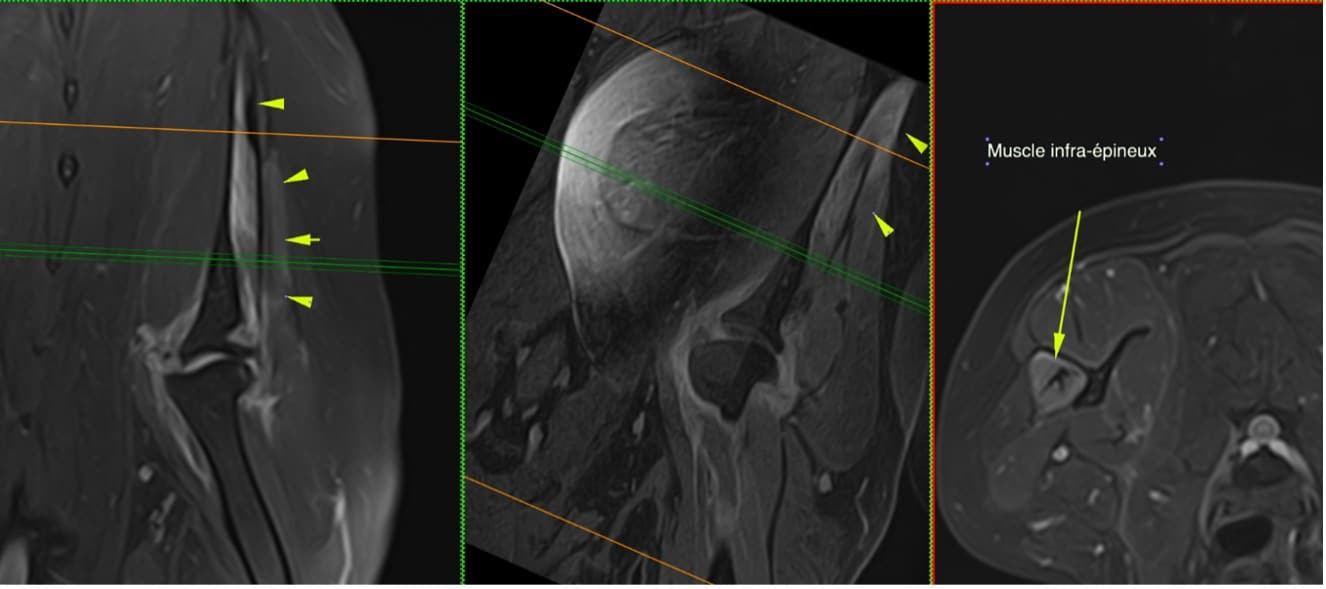 Prise en charge chirurgicale d'une contracture du muscle infraépineux